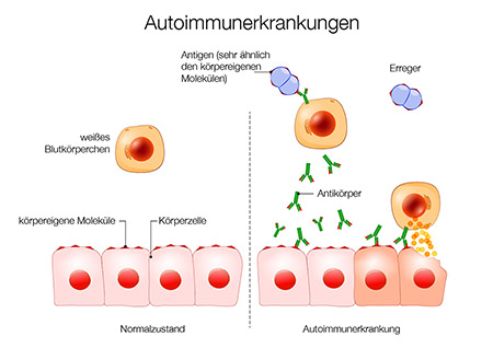 Autoimmunerkrankung: wenn das Immunsystem aus der Balance gerät