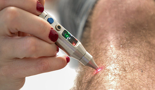 Lasertherapie: Stimulation der Mikrozirkulation für bessere Heilung